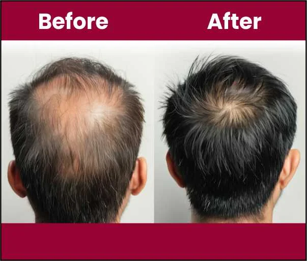 Hair Fall And Hair Loss